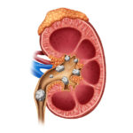 Kidney Stone Care